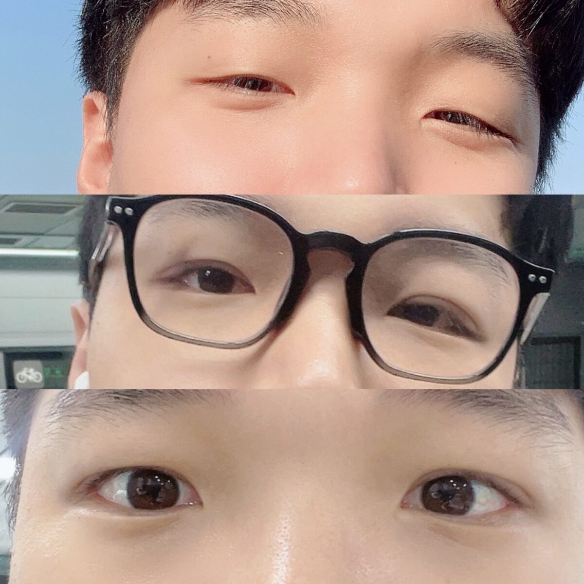 都彦禄院长   埋线双眼皮+提肌（男士）