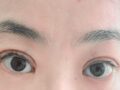 รีวิวการผ่าตัดทำตาสองชั้น (การผ่าตัดเปลือกตาบน + การกรีดแผล)