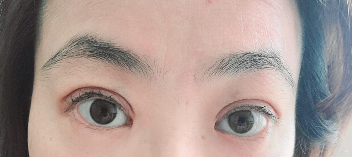 全切双眼皮+上眼睑    术后反馈
