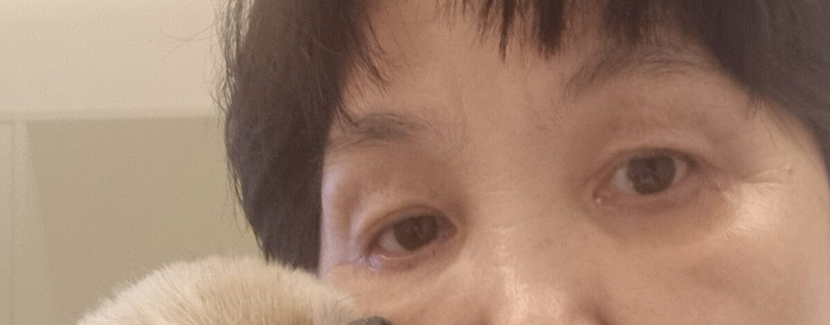上眼睑脂肪重置