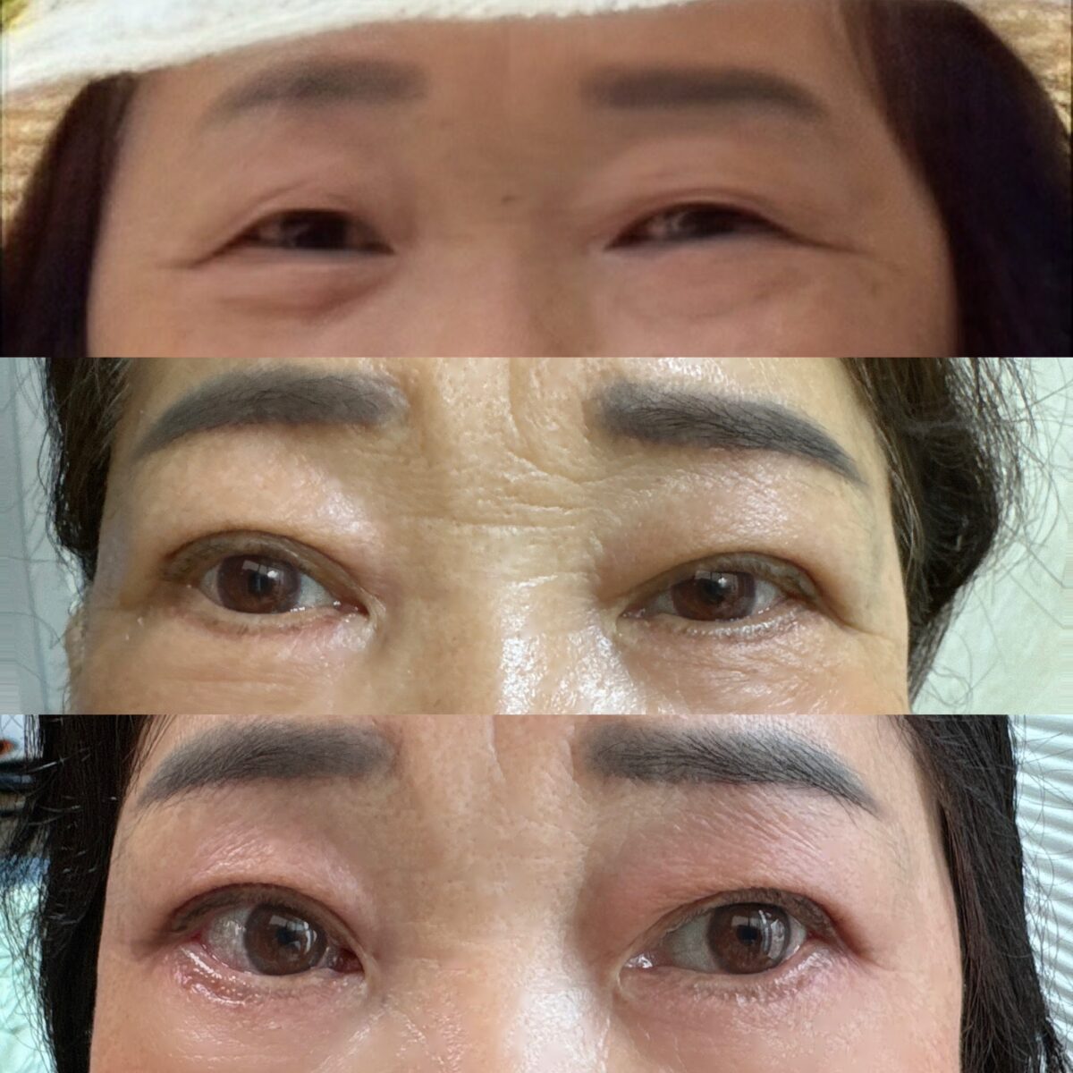 金洪振院长   双眼皮手术（中年整形） 术后反馈