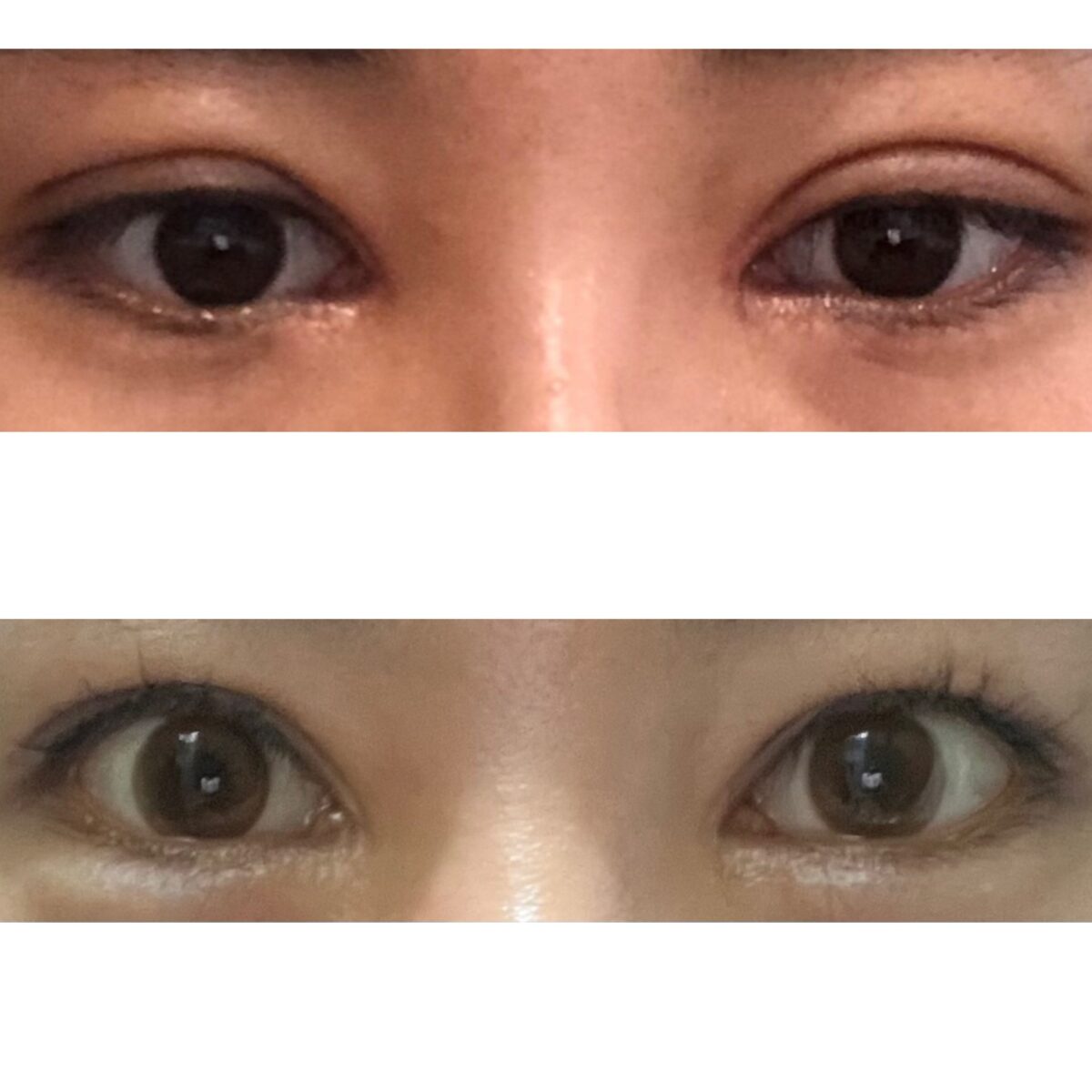 我的第五次双眼皮修复  终于成功了
