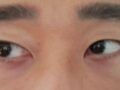 รีวิวหลังการผ่าตัดจัดตำแหน่งไขมันใต้ตา 2 เดือน โดยผู้กำกับ โด ออน-ร็อก