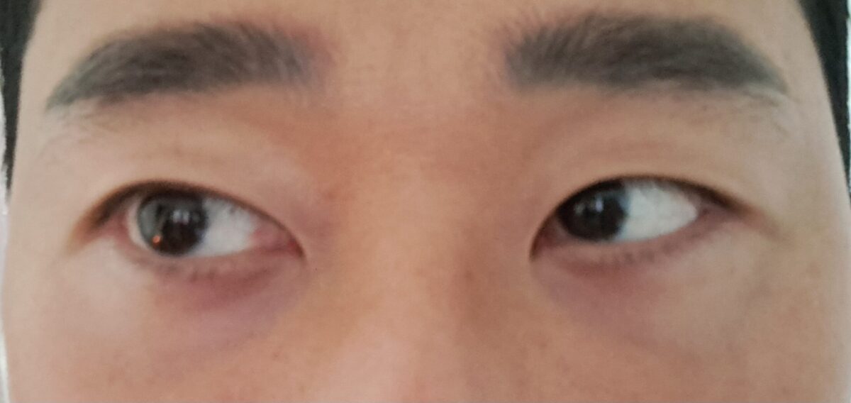 都彦禄院长   眼底脂肪重排  2个月 术后反馈
