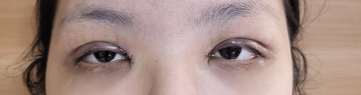 双眼皮手术 反馈