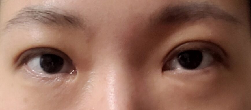 都彦禄院长  全切双眼皮修复