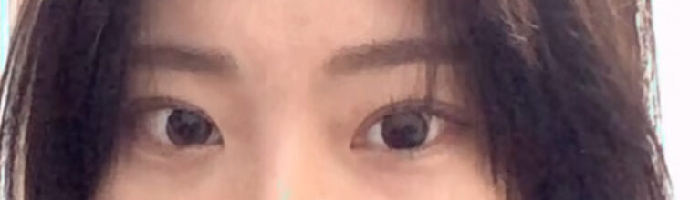 自然粘连  术后反馈