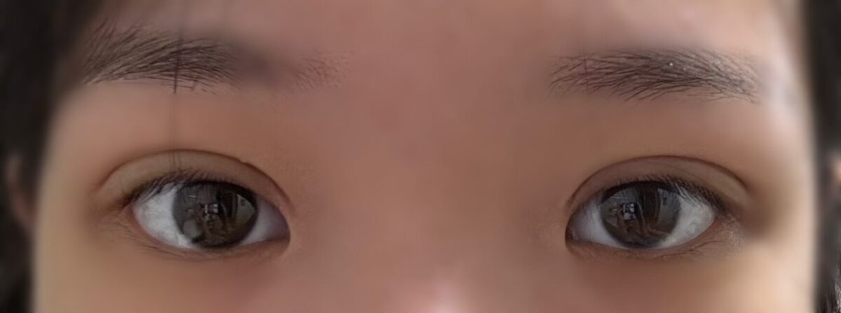 双眼皮修复反馈