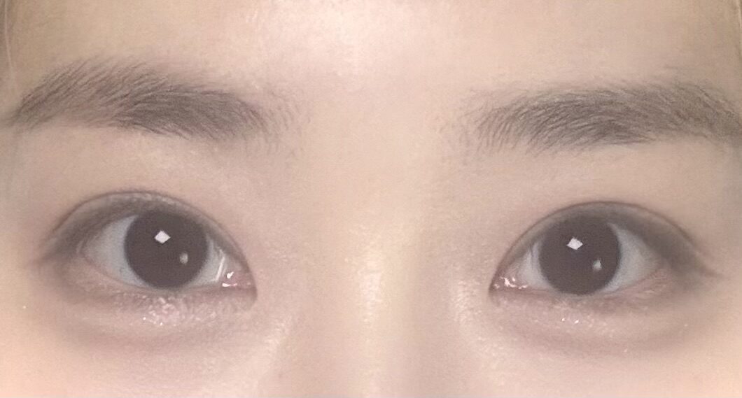 都彦禄院长  双眼皮手术  术后反馈