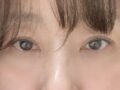 都彦禄院长 上眼睑+眼底脂肪填充~🩷💖