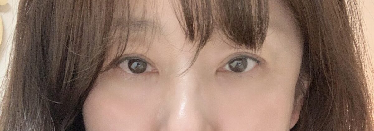 都彦禄院长 上眼睑+眼底脂肪填充~🩷💖