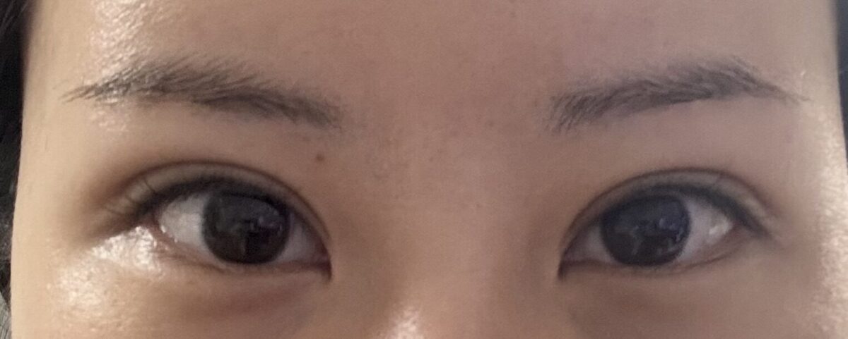 都彦禄院长  双眼皮修复反馈