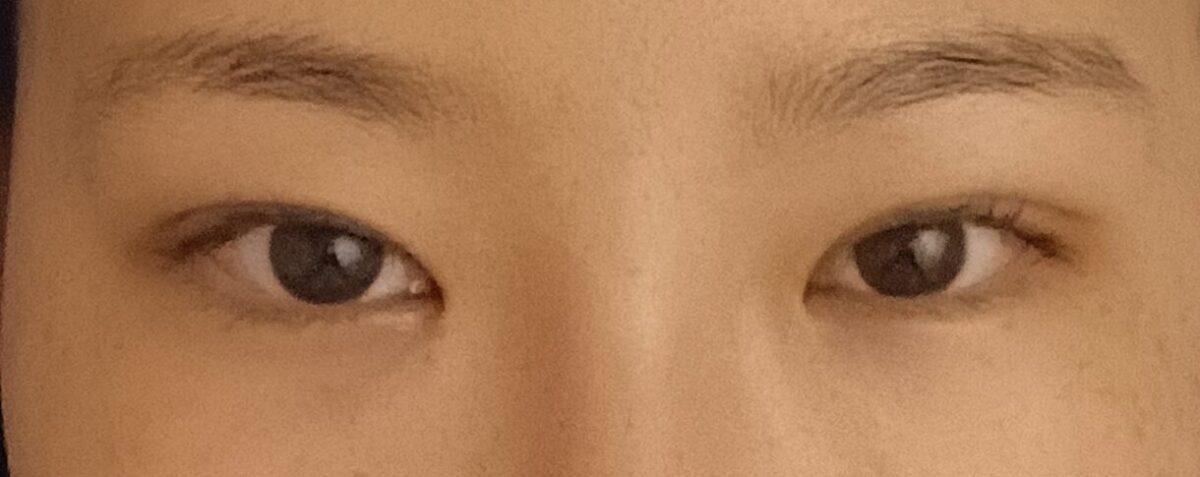 ผู้กำกับ โด ออน-ร็อก / ศัลยกรรมตกแต่งเปลือกตาสองชั้นแบบไม่ต้องผ่าตัด