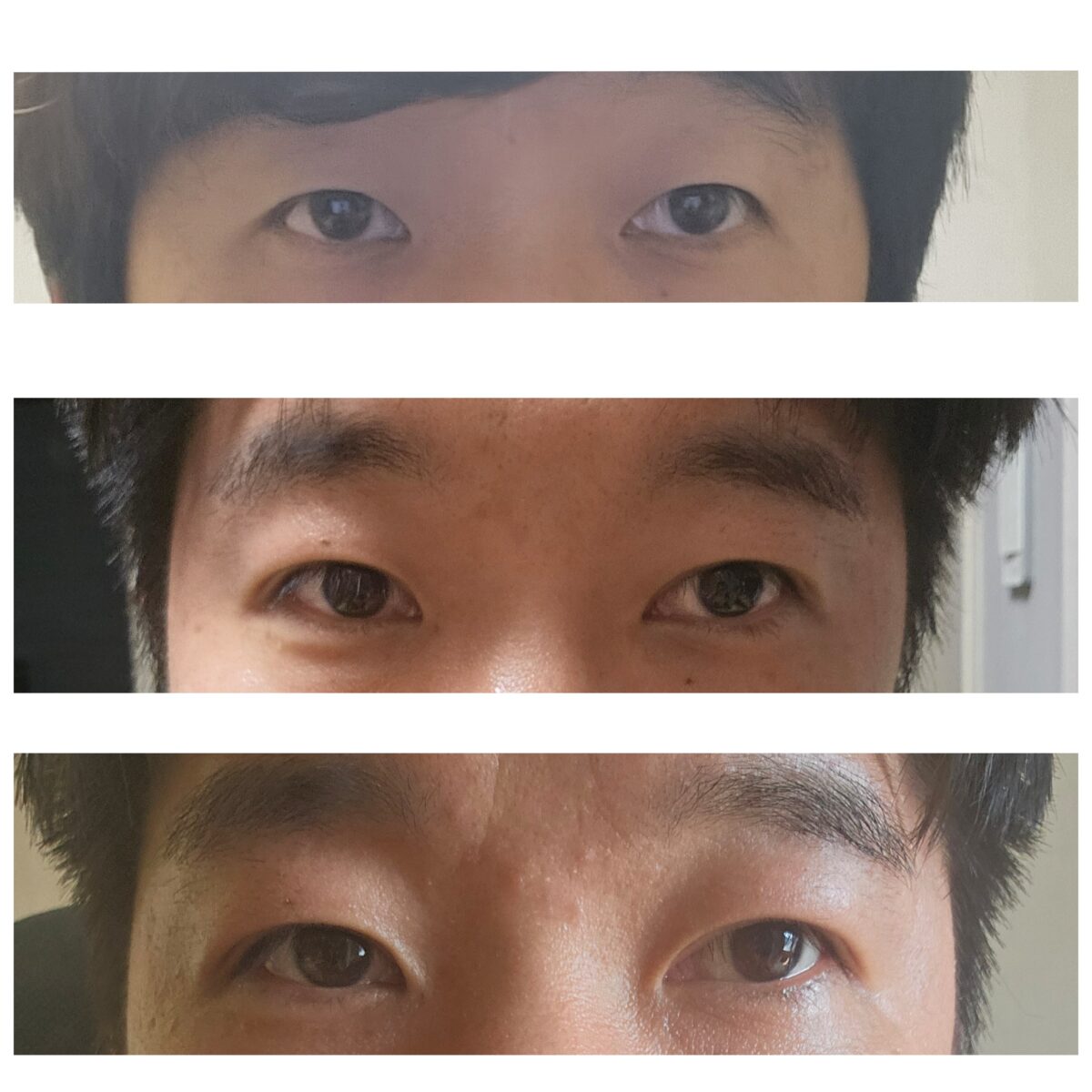 道言録院長眼剣下水（切開）2ヶ月後期