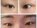 ผู้กำกับ โด ออน-ร็อก - รีวิวการผ่าตัดตา