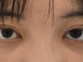 1 เดือนหลังผ่าตัดทำตาสองชั้น