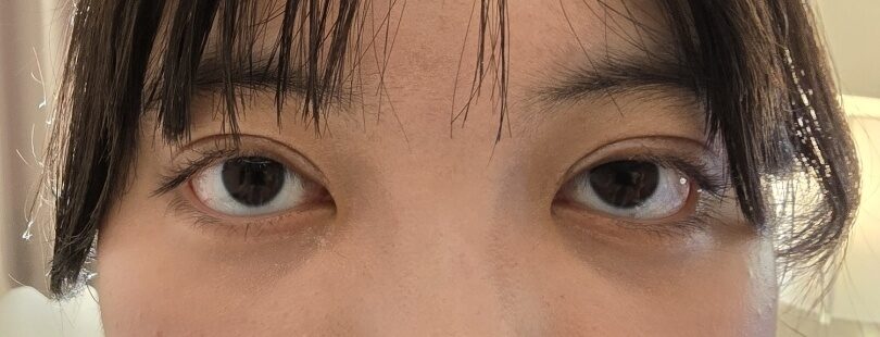 双眼皮手术后1个月