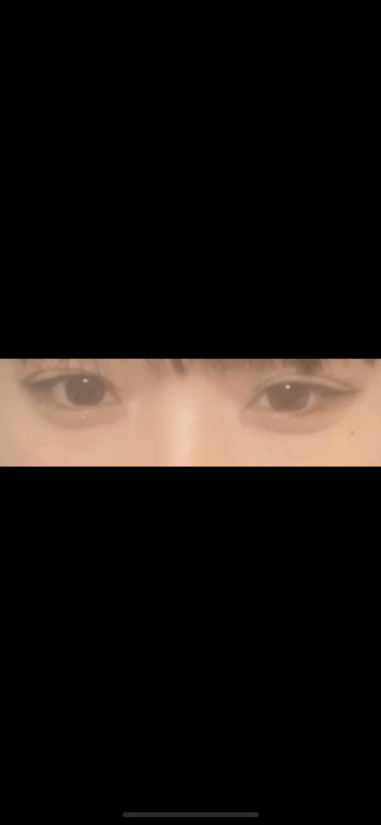 都彦禄院长  全切双眼皮+上眼角+提肌 反馈