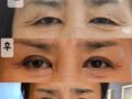 都彦禄代表院长做的 上眼角手术