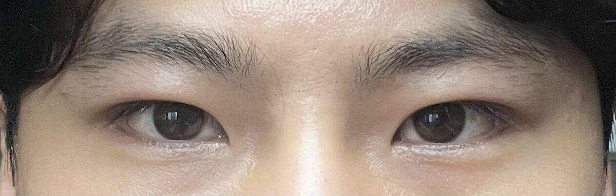 都彦禄院长  双眼皮手术  术后反馈