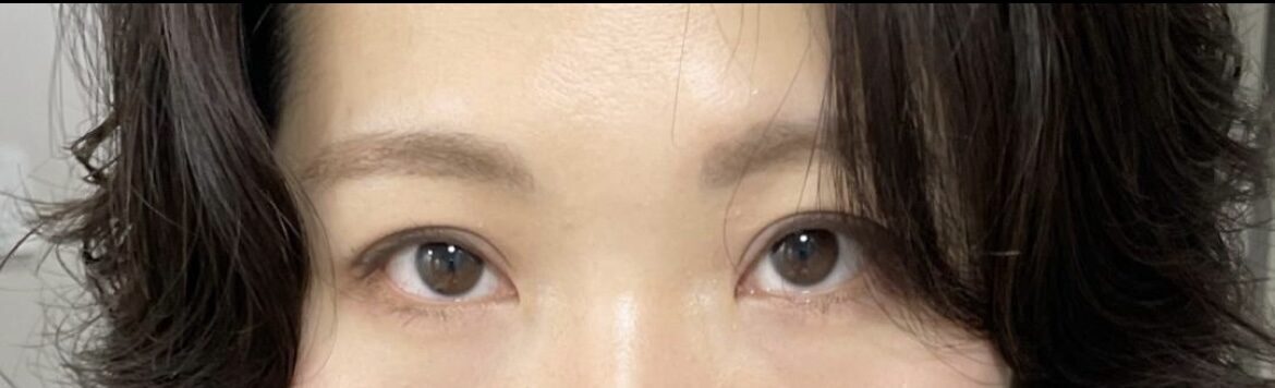 都彦禄院长  初眼 术后反馈
