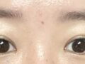 ยกกระชับเปลือกตาบนแบบไม่ผ่าตัด +