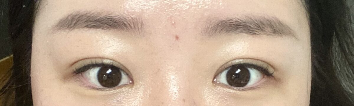 埋线双眼皮+上眼角  术后反馈
