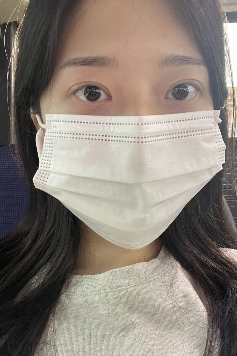 都彦禄院长  双眼皮修复 术后反馈