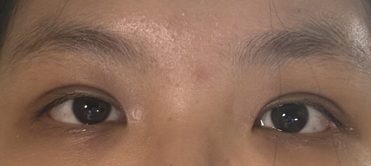 双眼皮手术评价