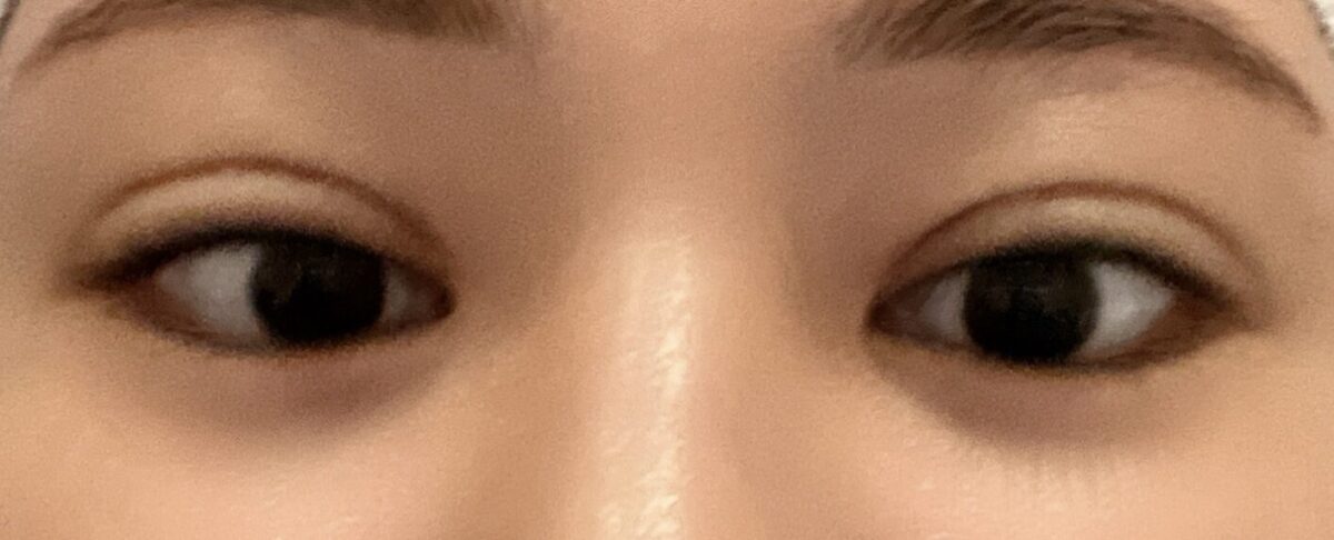 都彦禄院长   双眼皮修复  术后