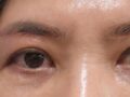 眉毛巨像術と目下脂肪再配置手術