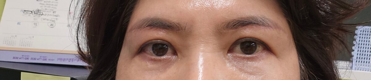 切眉提肌+眼底脂肪重排  手术