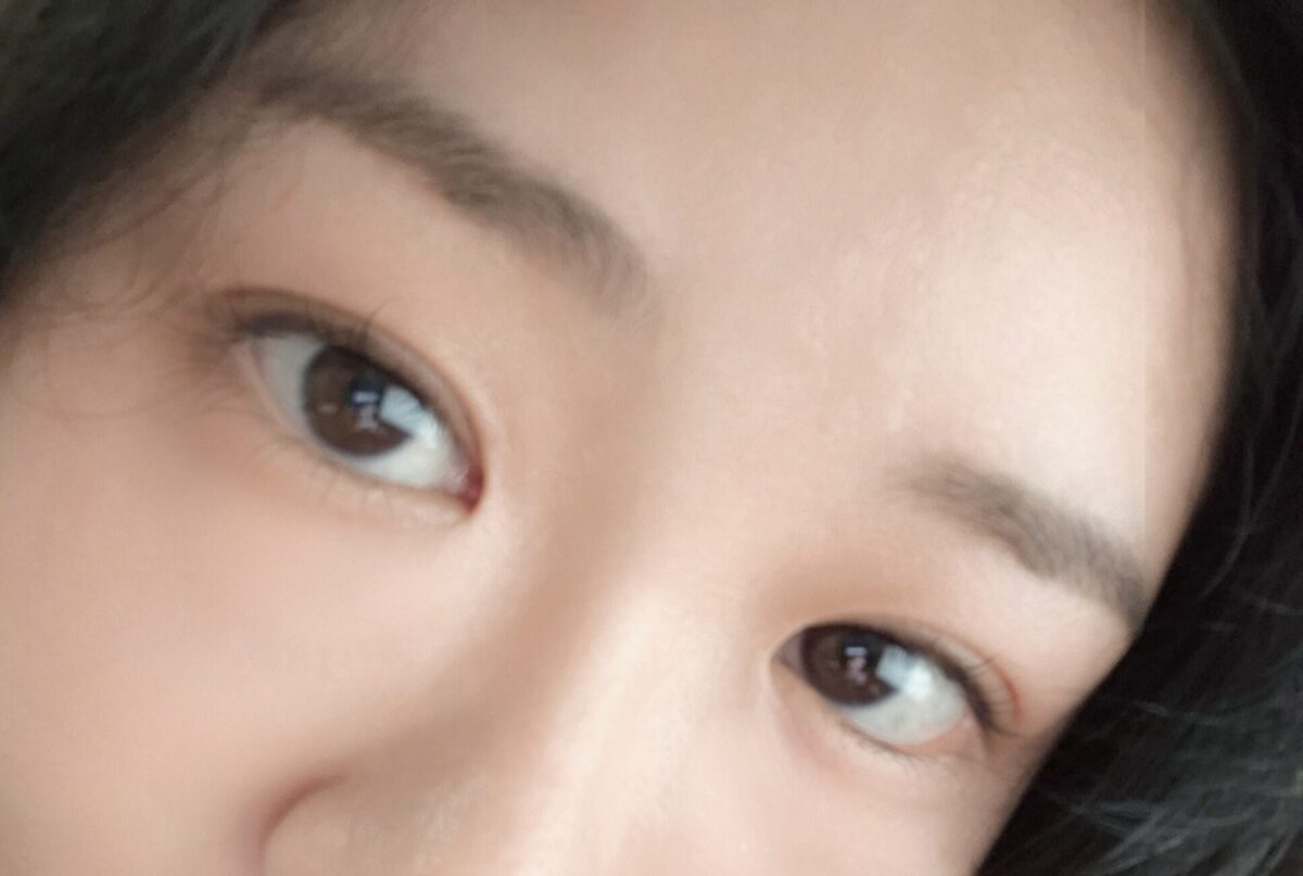 都彦禄院长  双眼皮修复手术