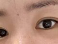 การยกกระชับเปลือกตาบน + เย็บแผลซ่อนตะเข็บ โดยคุณหมอโด ออน-ร็อก หลังผ่าตัด 2 เดือน