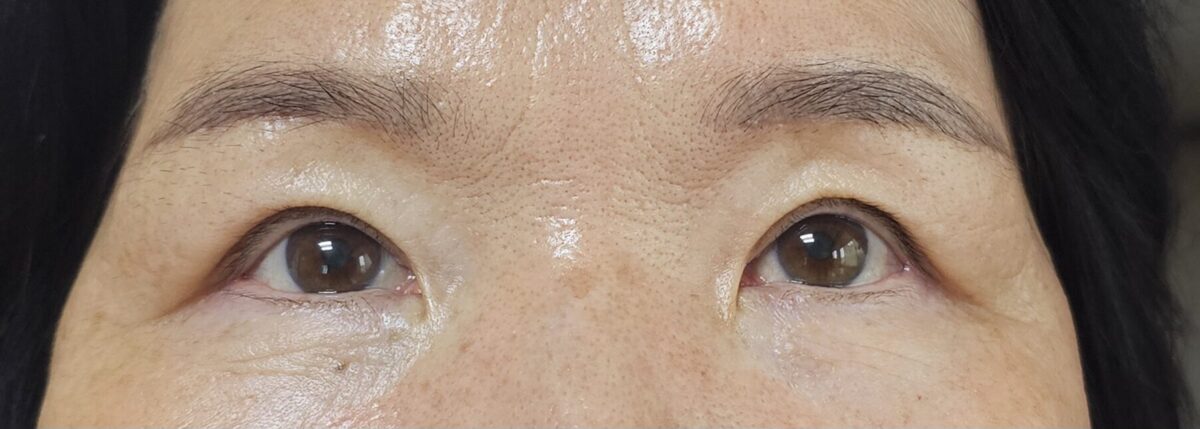 对金洪振院长做的 上眼角+自然粘连手术的反馈