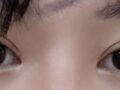 都彦禄院长  双眼皮修复  术后2个月