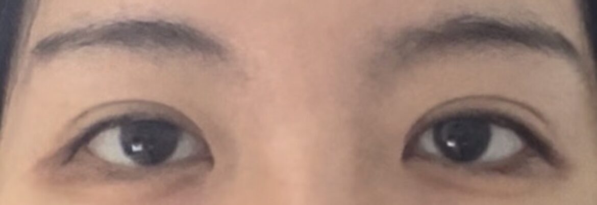 全切双眼皮(修复)+ 上眼角   术后反馈