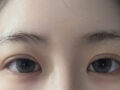 金洪振院长   埋线双眼皮+上眼角   修复   术后反馈 