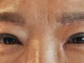 对都彦禄院长的提眉术的反馈