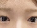 ฉันเข้ารับการผ่าตัดตาที่โรงพยาบาลอิลมิริ โด ออน-ร็อก