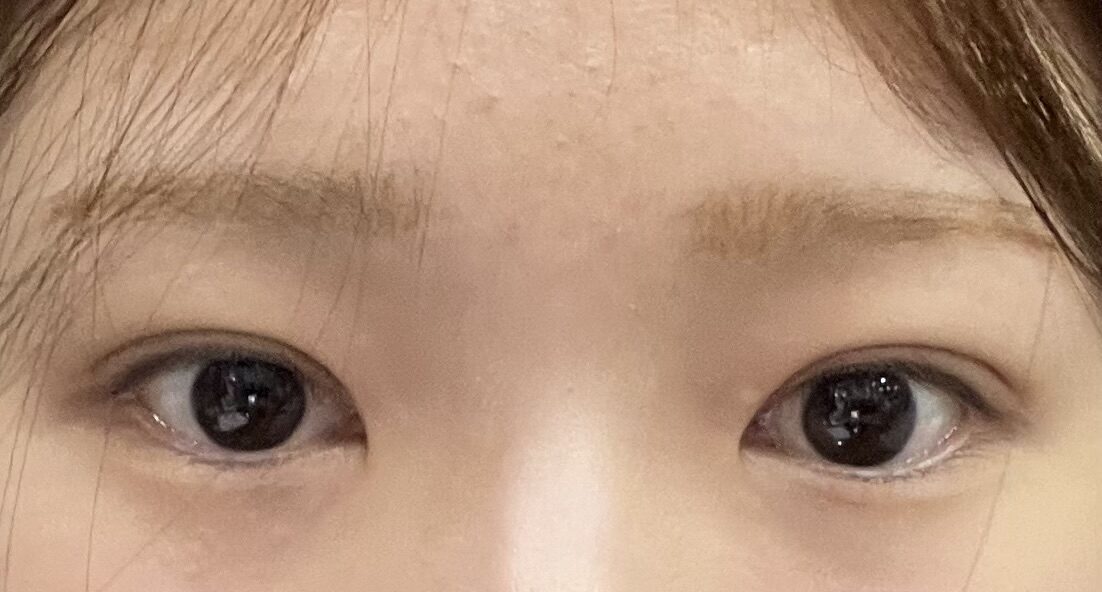 在一毫米 都彦禄院长这里做了 双眼皮手术