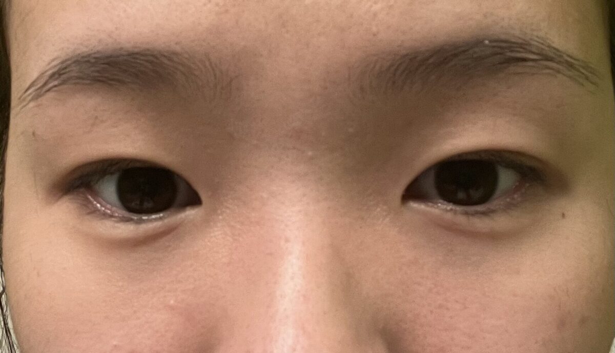 รีวิว 2 เดือนหลังผ่าตัดทำตาสองชั้น