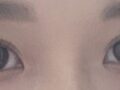 การแก้ไขการยึดเกาะตามธรรมชาติ + การตรวจติดตามการผ่าตัดตกแต่งหัวตา