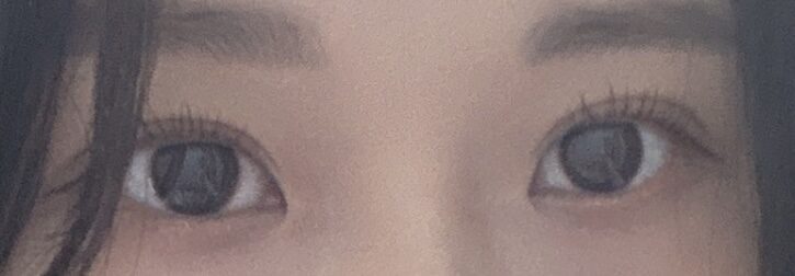 การแก้ไขการยึดเกาะตามธรรมชาติ + การตรวจติดตามการผ่าตัดตกแต่งหัวตา