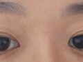 รีวิวการผ่าตัดทำตาสองชั้นของ ดร.โด วอน-รก