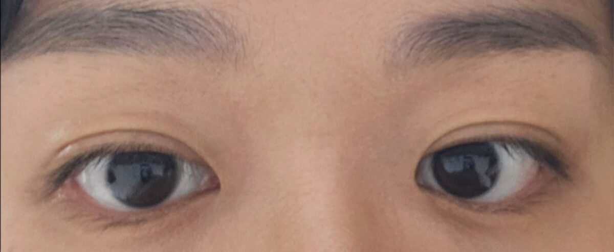รีวิวการผ่าตัดทำตาสองชั้นของ ดร.โด วอน-รก