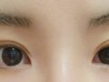 在罗院长这里做了切开双眼皮修复＋开眼角！！