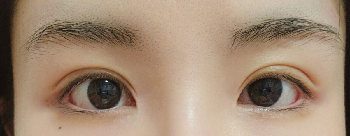 在罗院长这里做了切开双眼皮修复＋开眼角！！