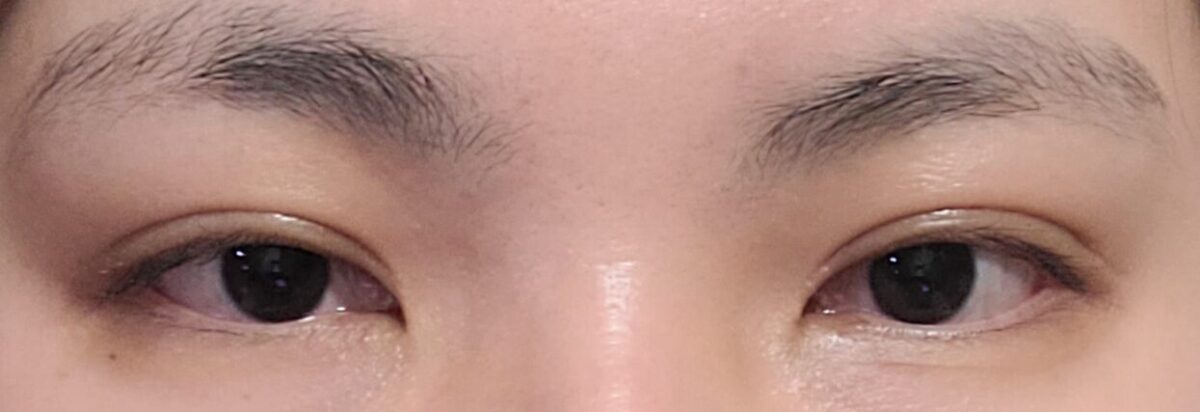 都彦禄院长 自然粘连双眼皮  术后2个月反馈