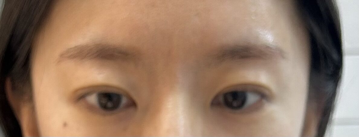 都彦禄院长  自然粘连 术后反馈